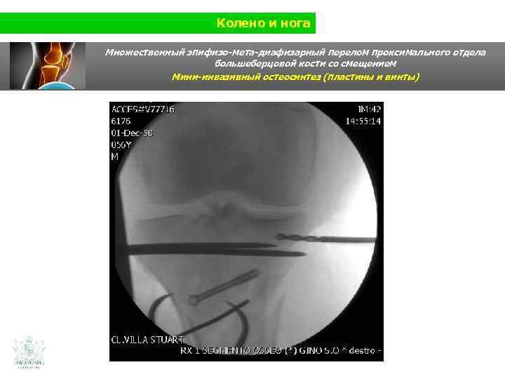 Колено и нога Множественный эпифизо-мета-диафизарный перелом проксимального отдела большеберцовой кости со смещением Мини-инвазивный остеосинтез