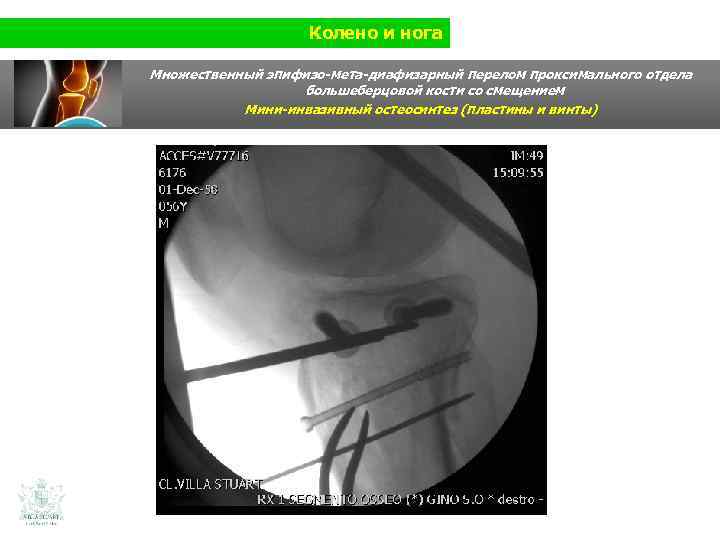 Колено и нога Множественный эпифизо-мета-диафизарный перелом проксимального отдела большеберцовой кости со смещением Мини-инвазивный остеосинтез