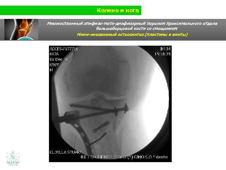 Колено и нога Множественный эпифизо-мета-диафизарный перелом проксимального отдела большеберцовой кости со смещением Мини-инвазивный остеосинтез