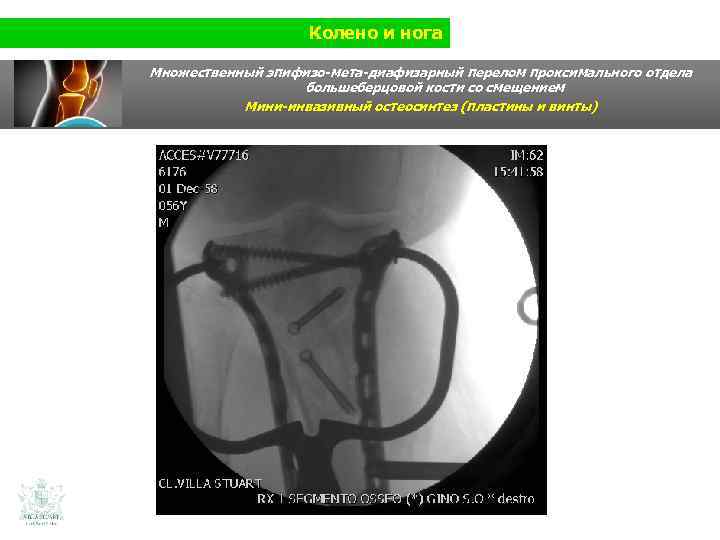 Колено и нога Множественный эпифизо-мета-диафизарный перелом проксимального отдела большеберцовой кости со смещением Мини-инвазивный остеосинтез