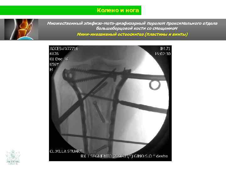 Колено и нога Множественный эпифизо-мета-диафизарный перелом проксимального отдела большеберцовой кости со смещением Мини-инвазивный остеосинтез