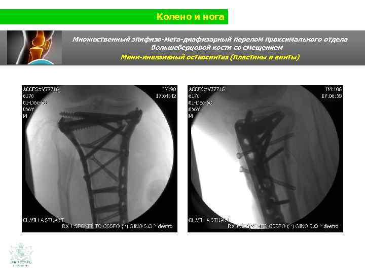 Колено и нога Множественный эпифизо-мета-диафизарный перелом проксимального отдела большеберцовой кости со смещением Мини-инвазивный остеосинтез