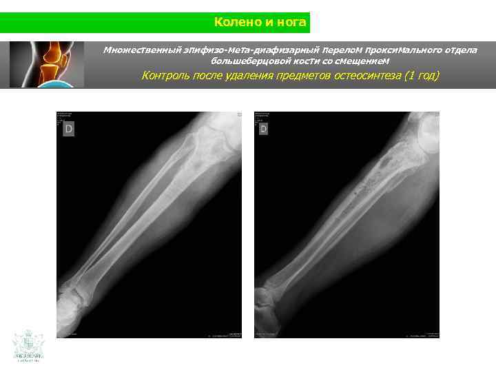 Колено и нога Множественный эпифизо-мета-диафизарный перелом проксимального отдела большеберцовой кости со смещением Контроль после