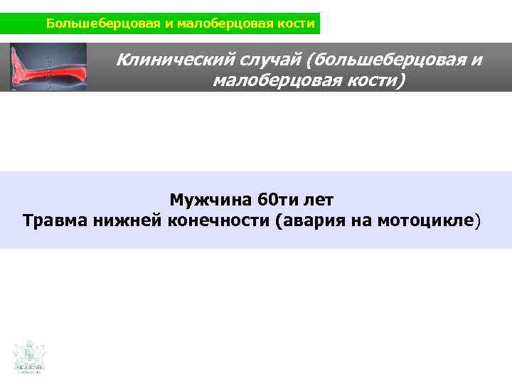 Большеберцовая и малоберцовая кости Клинический случай (большеберцовая и малоберцовая кости) Мужчина 60 ти лет