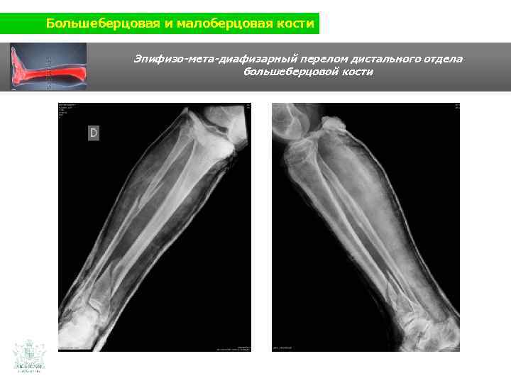 Большеберцовая и малоберцовая кости Эпифизо-мета-диафизарный перелом дистального отдела большеберцовой кости 