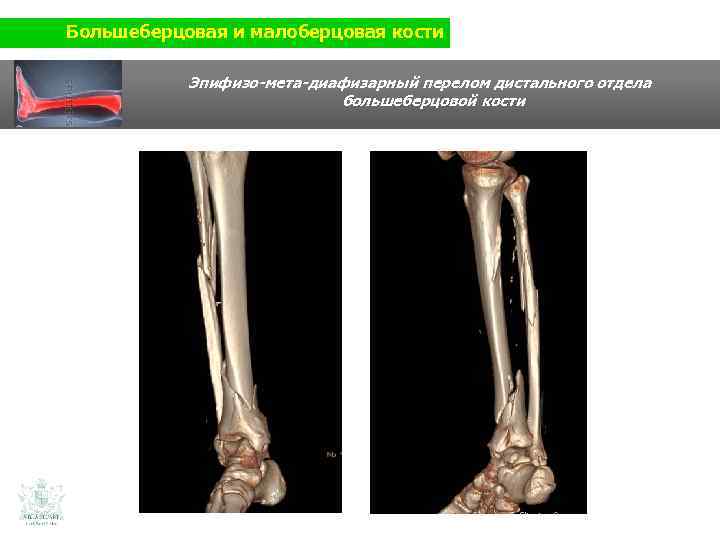 Большеберцовая и малоберцовая кости Эпифизо-мета-диафизарный перелом дистального отдела большеберцовой кости 