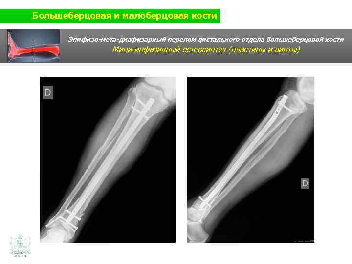 Большеберцовая и малоберцовая кости Эпифизо-мета-диафизарный перелом дистального отдела большеберцовой кости Мини-инфазивный остеосинтез (пластины и