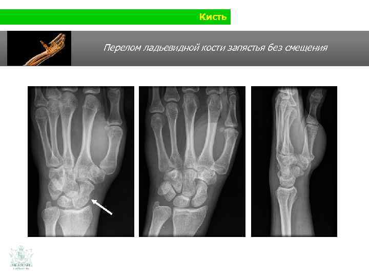 Кисть Перелом ладьевидной кости запястья без смещения 