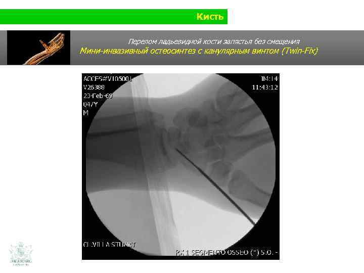 Кисть Перелом ладьевидной кости запястья без смещения Мини-инвазивный остеосинтез с канулярным винтом (Twin-Fix) 