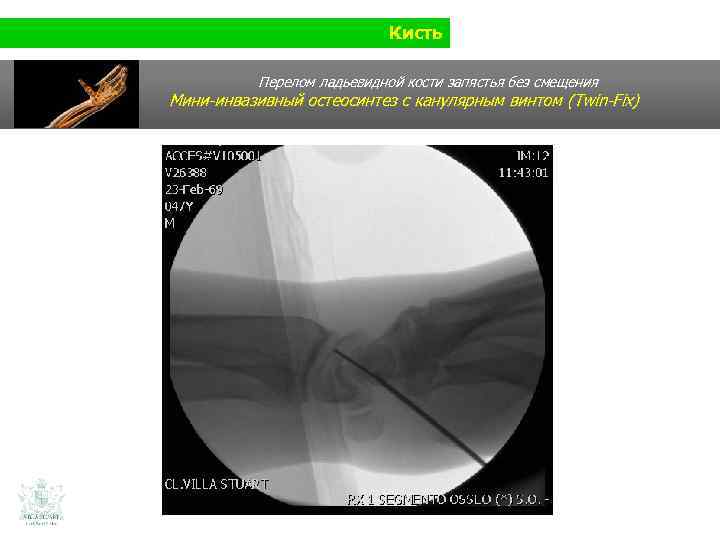 Кисть Перелом ладьевидной кости запястья без смещения Мини-инвазивный остеосинтез с канулярным винтом (Twin-Fix) 