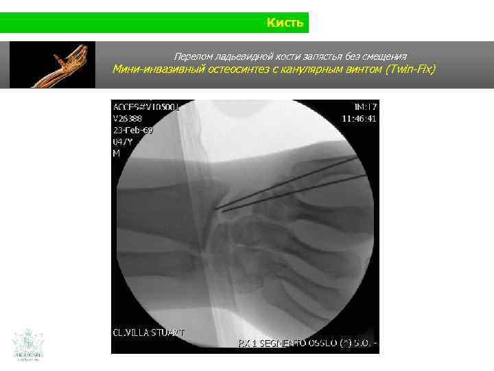 Кисть Перелом ладьевидной кости запястья без смещения Мини-инвазивный остеосинтез с канулярным винтом (Twin-Fix) 