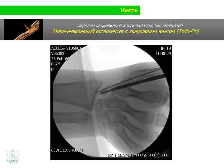 Кисть Перелом ладьевидной кости запястья без смещения Мини-инвазивный остеосинтез с канулярным винтом (Twin-Fix) 