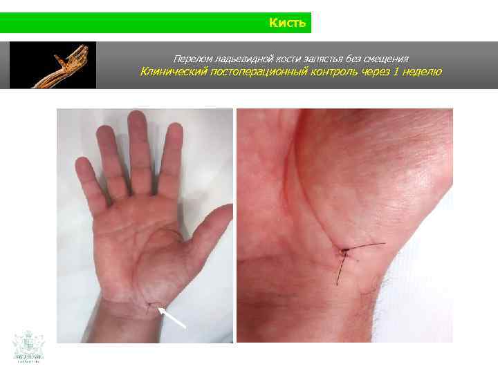 Кисть Перелом ладьевидной кости запястья без смещения Клинический постоперационный контроль через 1 неделю 