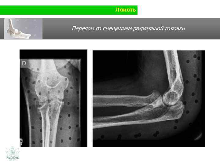 Локоть Перелом со смещением радиальной головки 