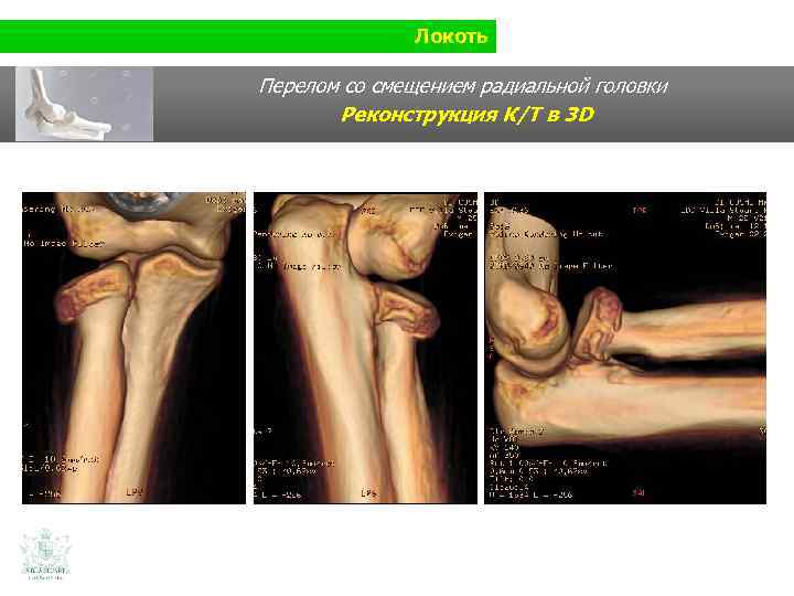 Локоть Перелом со смещением радиальной головки Реконструкция К/Т в 3 D 