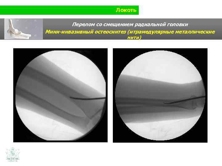 Локоть Перелом со смещением радиальной головки Мини-инвазивный остеосинтез (итрамедулярные металлические нити) 