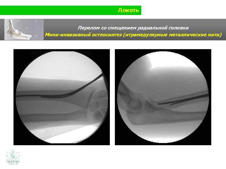 Локоть Перелом со смещением радиальной головки Мини-инвазивный остеосинтез (итрамедулярные металлические нити) 