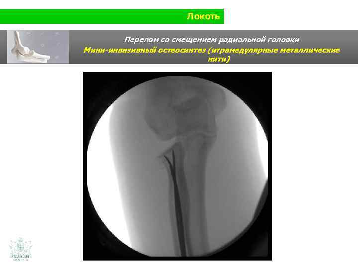 Локоть Перелом со смещением радиальной головки Мини-инвазивный остеосинтез (итрамедулярные металлические нити) 