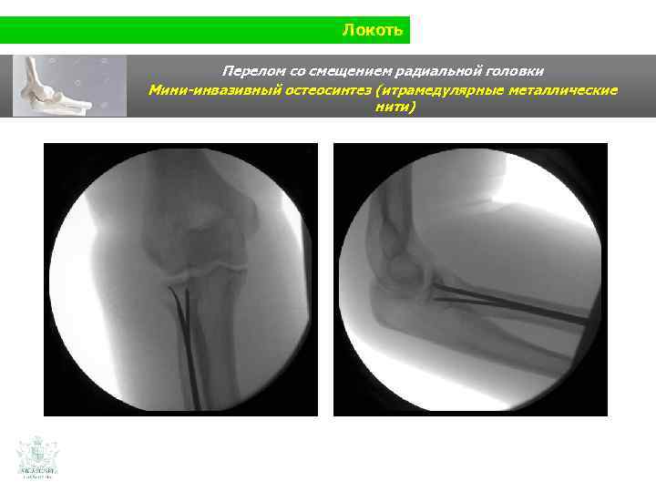 Локоть Перелом со смещением радиальной головки Мини-инвазивный остеосинтез (итрамедулярные металлические нити) 