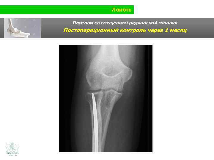 Локоть Перелом со смещением радиальной головки Постоперационный контроль через 1 месяц 