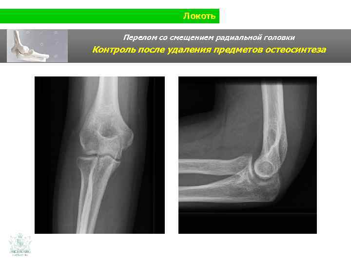 Локоть Перелом со смещением радиальной головки Контроль после удаления предметов остеосинтеза 