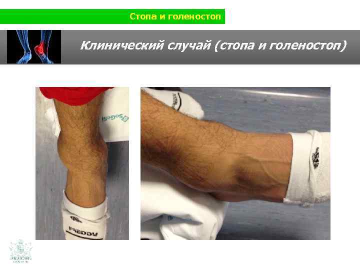 Стопа и голеностоп Клинический случай (стопа и голеностоп) 