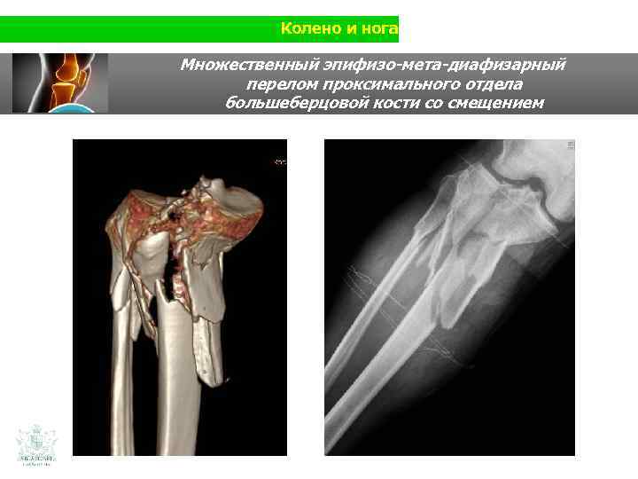 Колено и нога Множественный эпифизо-мета-диафизарный перелом проксимального отдела большеберцовой кости со смещением 