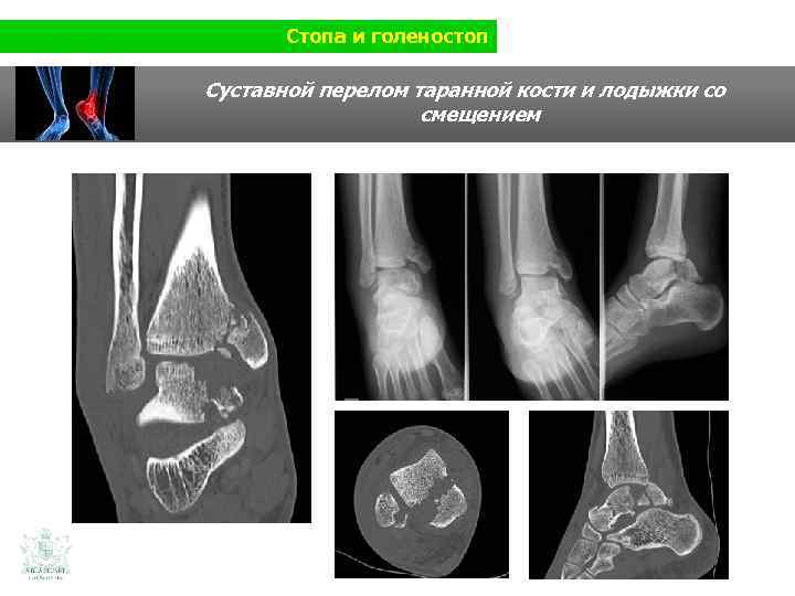 Стопа и голеностоп Суставной перелом таранной кости и лодыжки со смещением 