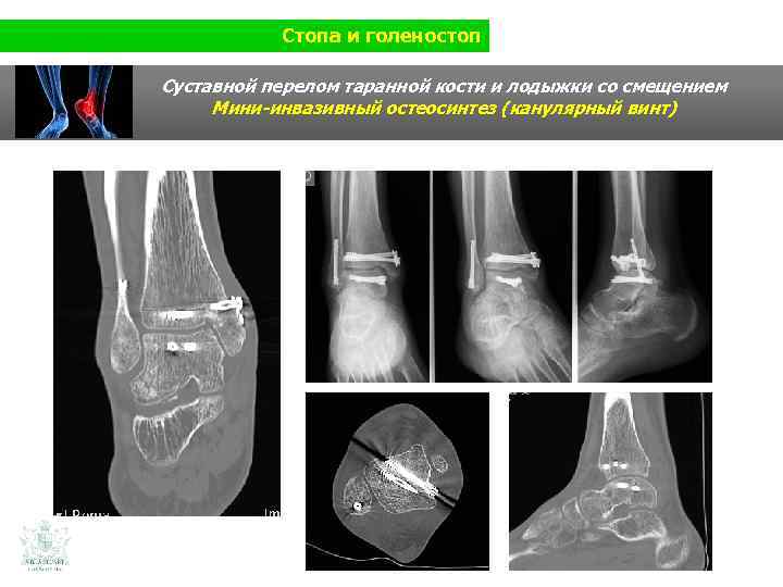 Стопа и голеностоп Суставной перелом таранной кости и лодыжки со смещением Мини-инвазивный остеосинтез (канулярный