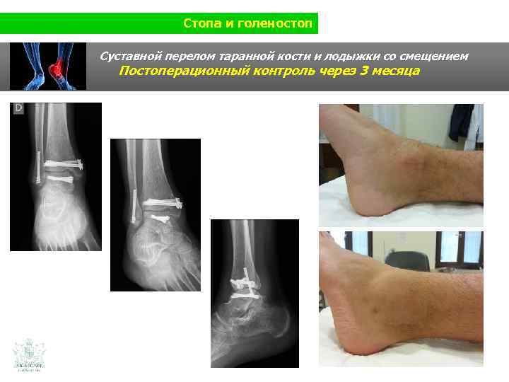 Стопа и голеностоп Суставной перелом таранной кости и лодыжки со смещением Постоперационный контроль через