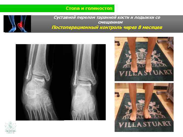 Стопа и голеностоп Суставной перелом таранной кости и лодыжки со смещением Постоперационный контроль через