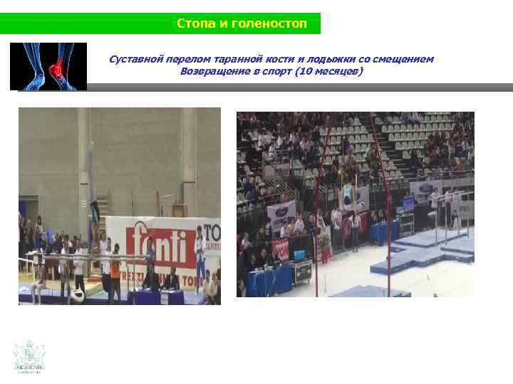 Стопа и голеностоп Суставной перелом таранной кости и лодыжки со смещением Возвращение в спорт