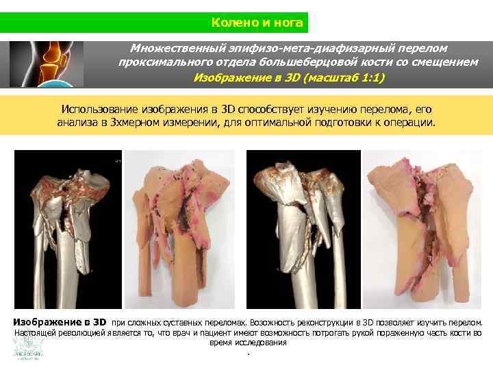 Колено и нога Множественный эпифизо-мета-диафизарный перелом проксимального отдела большеберцовой кости со смещением Изображение в