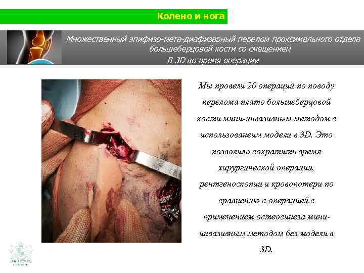 Колено и нога Множественный эпифизо-мета-диафизарный перелом проксимального отдела большеберцовой кости со смещением В 3