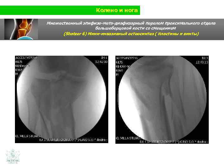 Колено и нога Множественный эпифизо-мета-диафизарный перелом проксимального отдела большеберцовой кости со смещением (Shatzer 6)