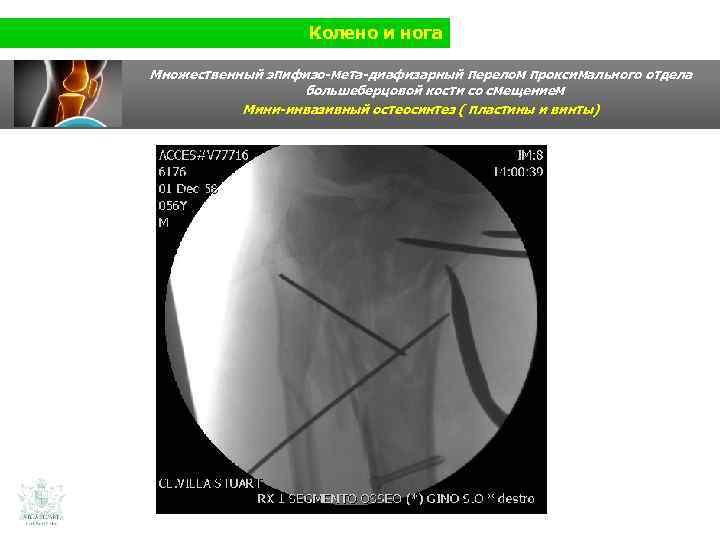 Колено и нога Множественный эпифизо-мета-диафизарный перелом проксимального отдела большеберцовой кости со смещением Мини-инвазивный остеосинтез