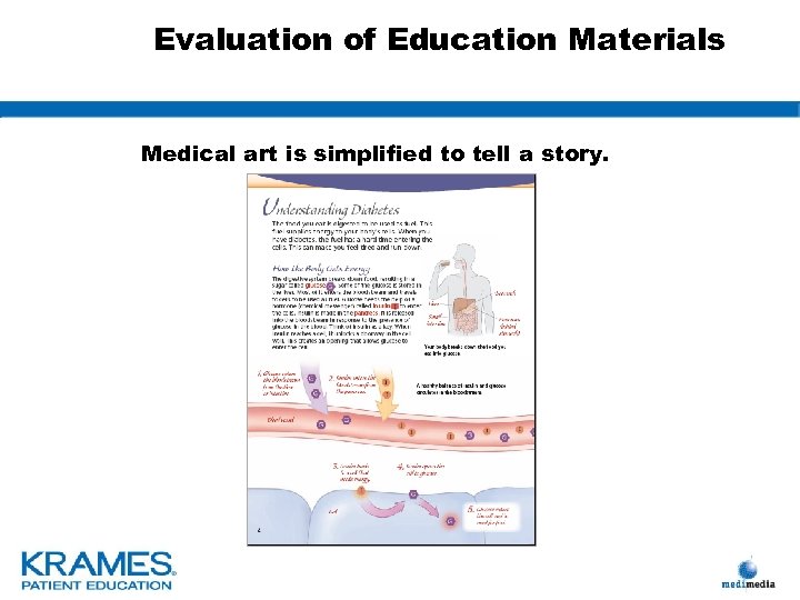 Evaluation of Education Materials Medical art is simplified to tell a story. 