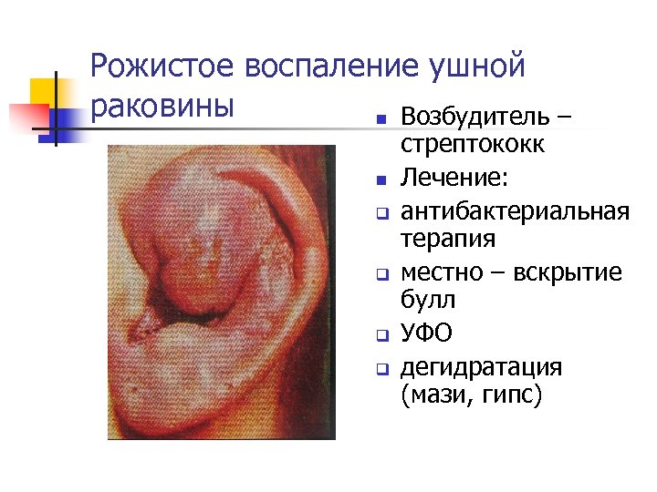 Рожистое воспаление ушной раковины n Возбудитель – n q q стрептококк Лечение: антибактериальная терапия