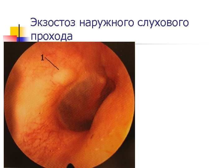 Экзостоз наружного слухового прохода 