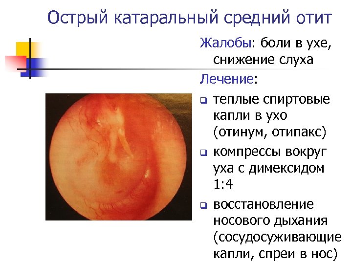 Острый катаральный средний отит Жалобы: боли в ухе, снижение слуха Лечение: q теплые спиртовые