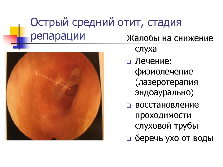 Острый средний отит, стадия репарации Жалобы на снижение q q q слуха Лечение: физиолечение
