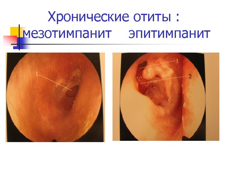 Хронические отиты : мезотимпанит эпитимпанит 