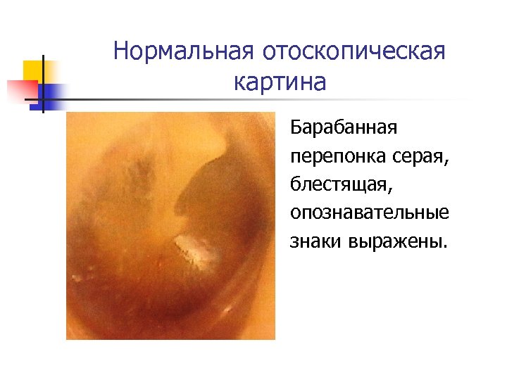Нормальная отоскопическая картина Барабанная перепонка серая, блестящая, опознавательные знаки выражены. 