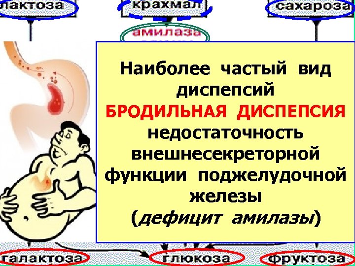 Наиболее частый вид диспепсий БРОДИЛЬНАЯ ДИСПЕПСИЯ недостаточность внешнесекреторной функции поджелудочной железы (дефицит амилазы) 