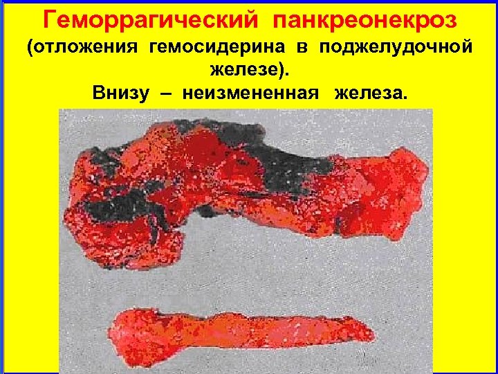 Геморрагический панкреонекроз (отложения гемосидерина в поджелудочной железе). Внизу – неизмененная железа. 
