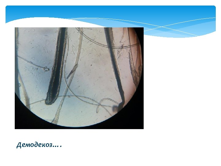 Демодекоз…. 