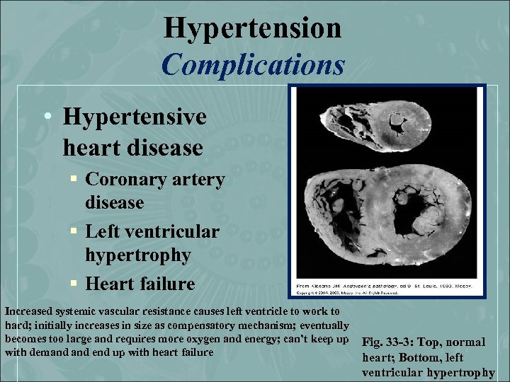 Hypertension Complications • Hypertensive heart disease § Coronary artery disease § Left ventricular hypertrophy
