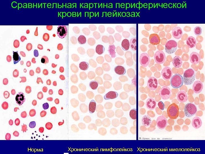 Картина крови при хроническом лимфолейкозе