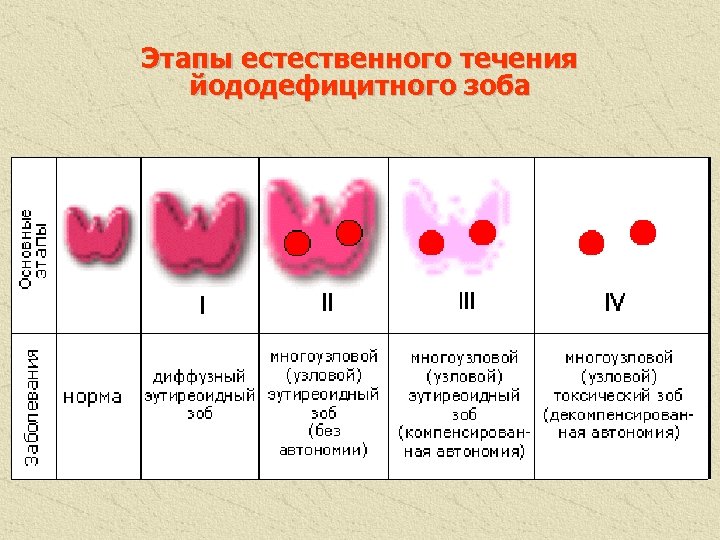 Этапы естественного течения йододефицитного зоба 