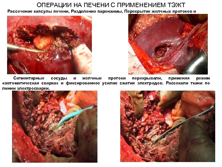 ОПЕРАЦИИ НА ПЕЧЕНИ С ПРИМЕНЕНИЕМ ТЭЖТ Рассечение капсулы печени, Разделение паренхимы, Перекрытие желчных протоков